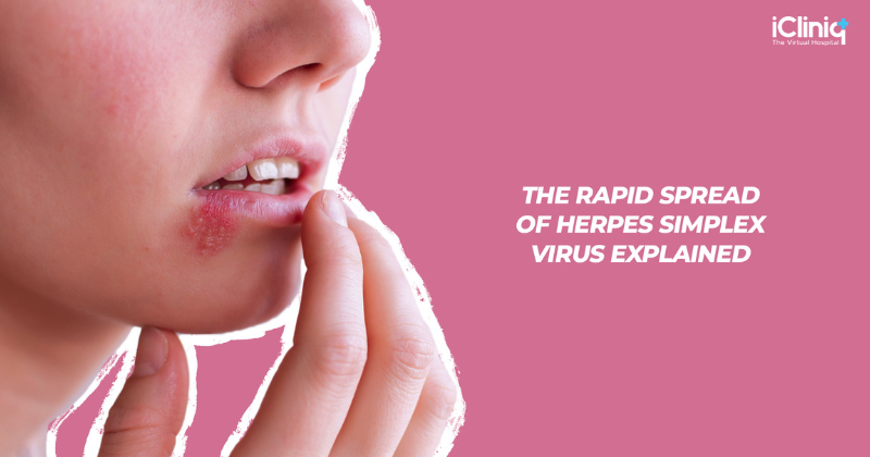 How Does Herpes Simplex Virus Spread So Quickly 5966