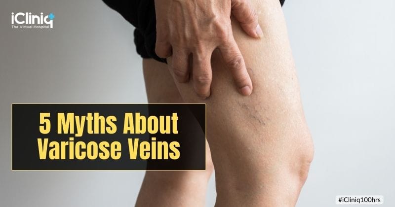 5 Myths About Varicose Veins