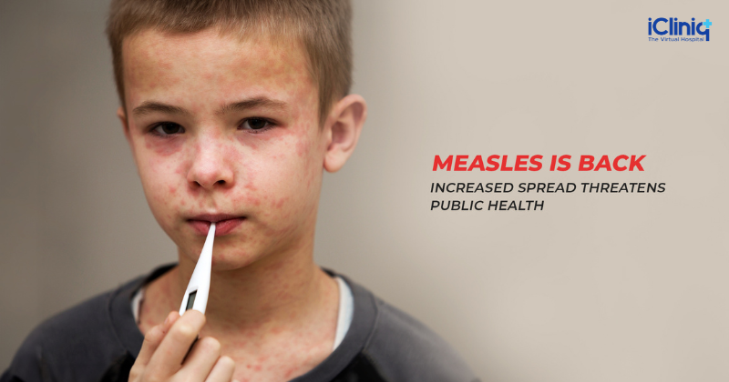 Measles Is Back: Increased Spread Threatens Public Health