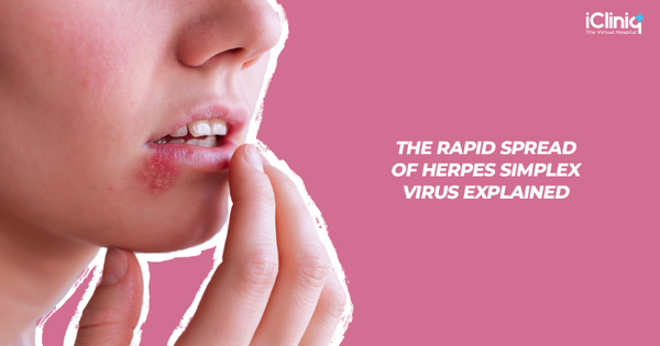 The Rapid Spread of Herpes Simplex Virus Explained